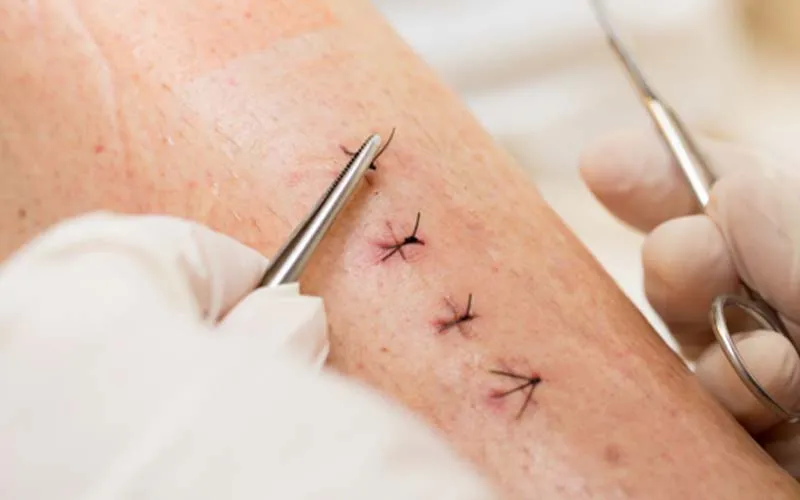 کشیدن بخیه در منزل تهران