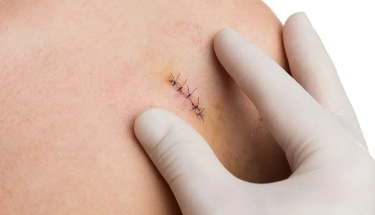 کشیدن بخیه در منزل تهران