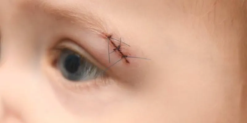 کشیدن بخیه در منزل تهران