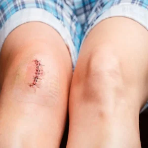 کشیدن بخیه در منزل تهران